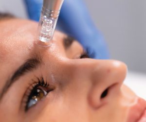 Microneedling behandeling uitgevoerd op het voorhoofd. Behadeling tegen littekens, huidveroudering, rimpels en pigmentvlekken